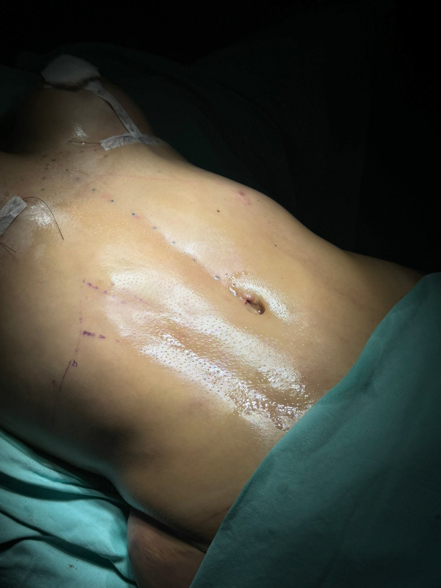 Resultado Lipoaspiração HD — Dr. Lauro Campos Cirurgião Plástico Salvador BA